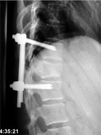 a picture showing X-ray of a patient with an unstable lumbar spinal fracture that has been fixed operatively with titanium pedicle screws.