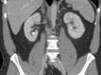 CT scan demonstrating kidney stone in lower pole of right kidney