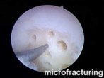 Preparation of cartilage defect