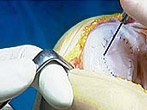 Membrane over cartilage defect
