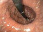 Endoscopic view of Hiatal hernia