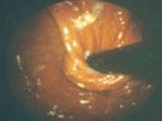 Endoscopic view following surgical repair with fundoplication
